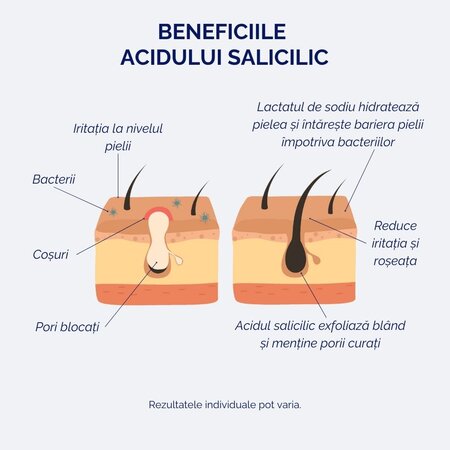 Ser cu acid salicilic 2%, pentru tenul sensibil si acneic, 30 ml, Meloni 608572