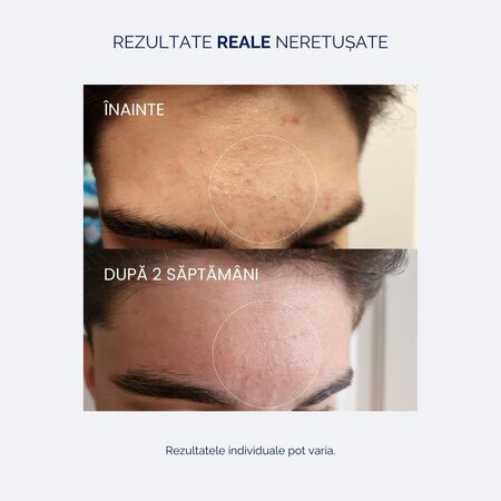 Ser cu acid salicilic 2%, pentru tenul sensibil si acneic, 30 ml, Meloni 608571