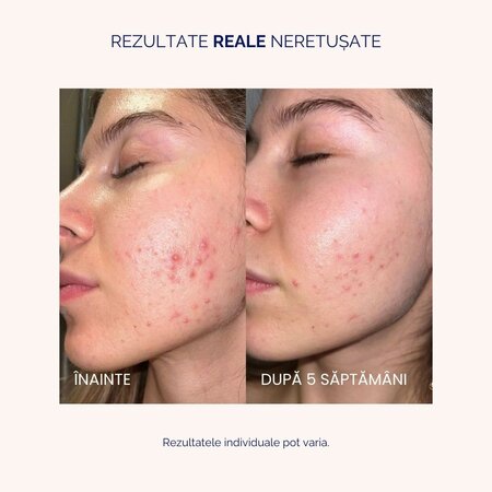 Ser vitamina C Lipozomala + AHA, PHA, acid kojic, acid lactic, 30 ml, Meloni 608577