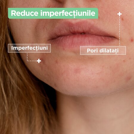 Crema hidratanta anti-imperfectiuni Anti Imperfection, 50 ml, Mixa 663680