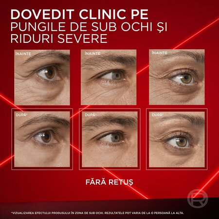 Crema corectoare pentru zona ochilor Revitalift Lase, 15 ml, L'Oreal Paris 663155