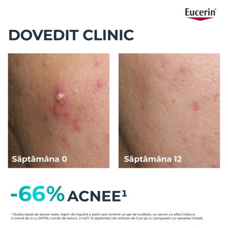 Ser cu tripla actiune Dermo Pure, 40 ml, Eucerin 665661