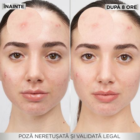 Plasturi invizibili pentru cosuri Pure Active, 8 bucati, Garnier 666069