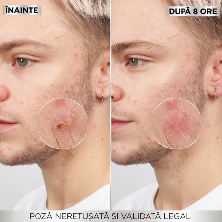Plasturi invizibili pentru cosuri Pure Active, 8 bucati, Garnier 666070