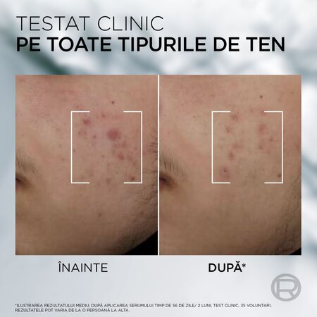 Serum anti-imperfectiuni pentru barbati Men Expert Derma Control, 30 ml, LOreal 715592