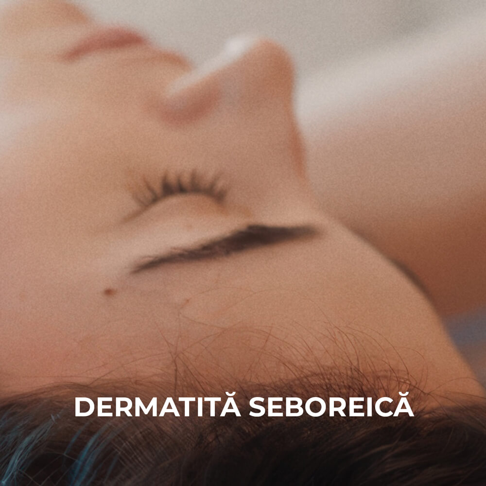Sesderma &mdash; Dermatita seboreica