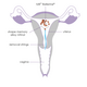 Sterilet IUB Ballerine, 1 bucata, Ocon Medical Ltd. 621543