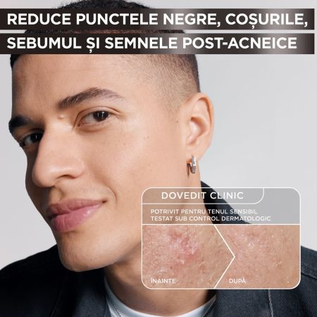 Serum anti-imperfectiuni cu niacinamide, AHA + BHA Pure Active, 30 ml, Garnier 658093