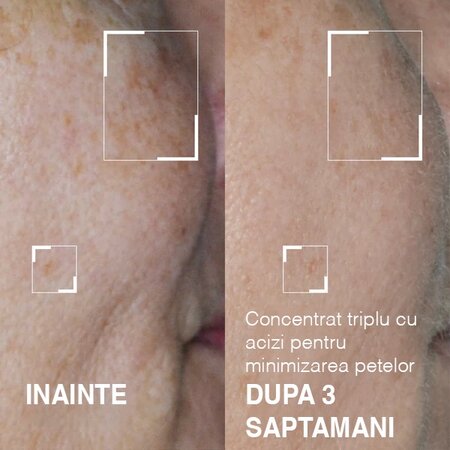 Concentrat triplu cu acizi pentru minimizarea petelor Dark Spots No More, 15 ml, Dr. Brandt 606064